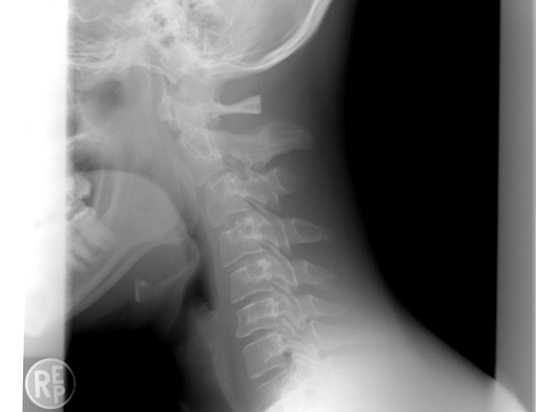 Chiropractic Lake in the Hills IL Neck X-Ray