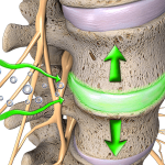 herniated disc treatment Dundee IL