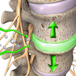 herniated disc treatment Gilberts IL