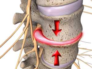 slipped disc treatment Inverness IL